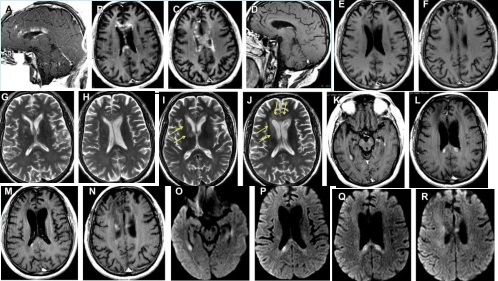 lymphocns31
